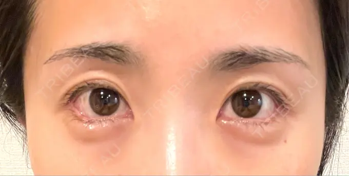 目尻切開 / タレ目形成・グラマラスライン（埋没） LOUIS CLINIC 二子玉川院【ルイクリニック】 DAY 7 メイン用