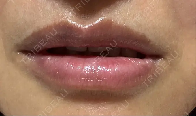 ヒアルロン酸注入（唇） アネシス美容クリニック DAY 3 メイン用