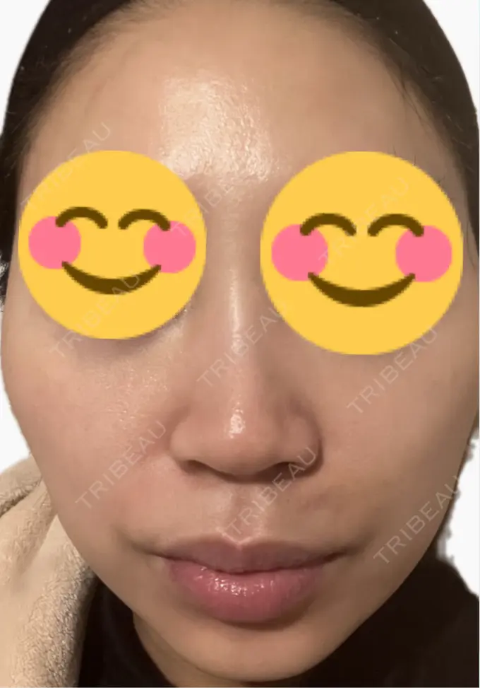 医療脱毛（顔） タイムルクリニック DAY 6 メイン用