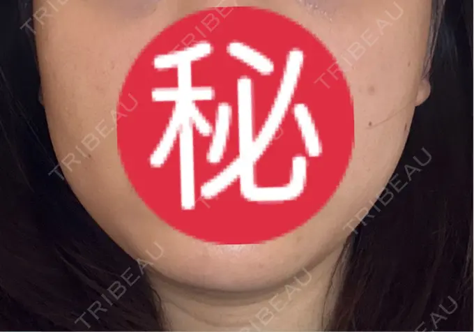 オンダリフト LIGHT CLINIC 【ライトクリニック】 名古屋院 DAY 2 メイン用