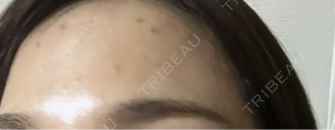 シミ取りレーザー S-Laboクリニック 渋谷院 AFTER メイン用