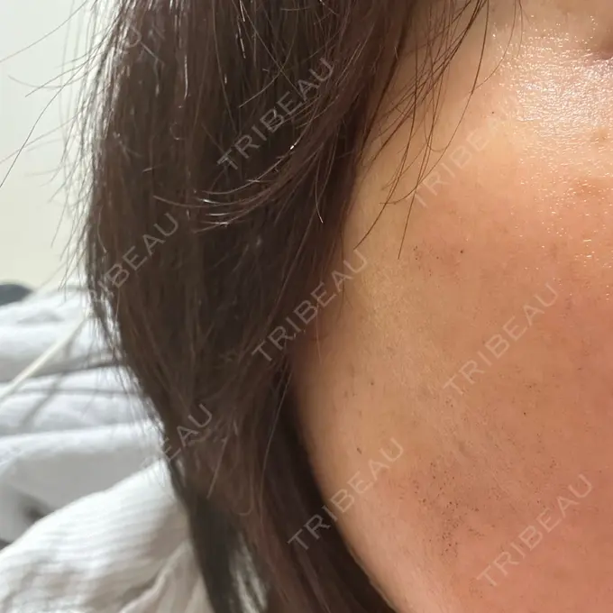 ルメッカ 東京美容外科 名古屋院 DAY 1 メイン用