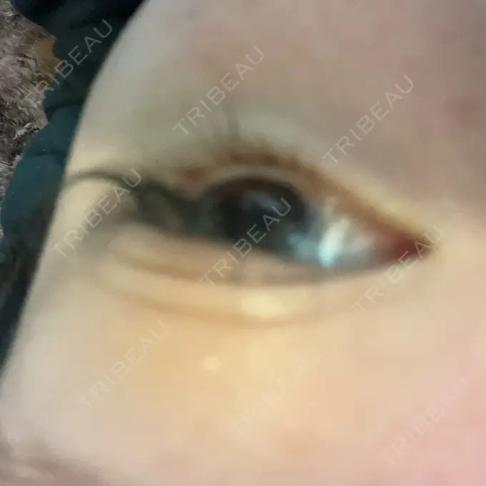 二重埋没 / ヒアルロン酸注入（涙袋） / ボトックス（エラ・小顔） / ヒアルロン酸注入（唇） / ボトックス（眉間） ネビュラクリニック 東京錦糸町院 AFTER メイン用