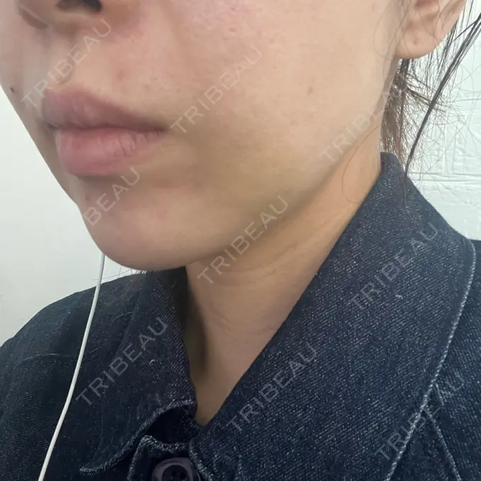 糸リフト / 脂肪吸引（顔） / 脂肪吸引注射（顔） ziz CLINIC DAY 2 メイン用