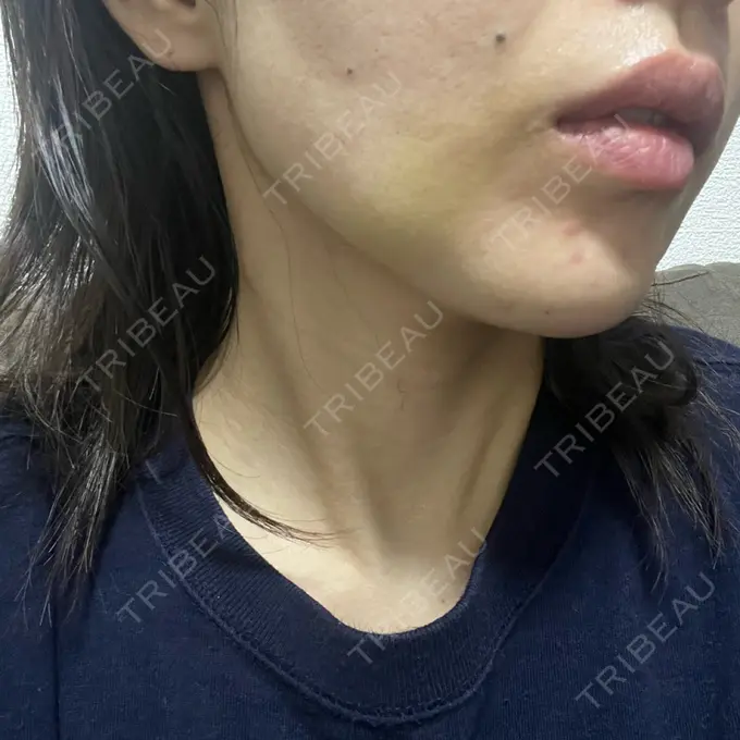 糸リフト / 脂肪吸引（顔） / 脂肪吸引注射（顔） ziz CLINIC AFTER メイン用