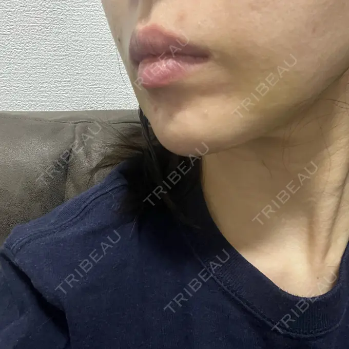 糸リフト / 脂肪吸引（顔） / 脂肪吸引注射（顔） ziz CLINIC DAY 3 メイン用