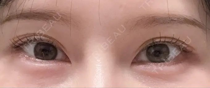 ヒアルロン酸注入（涙袋） TCB東京中央美容外科 名古屋栄院 DAY 0 メイン用