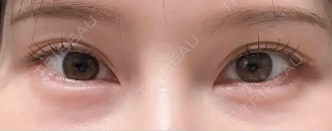 ヒアルロン酸注入（涙袋） TCB東京中央美容外科 名古屋栄院 DAY 0 メイン用