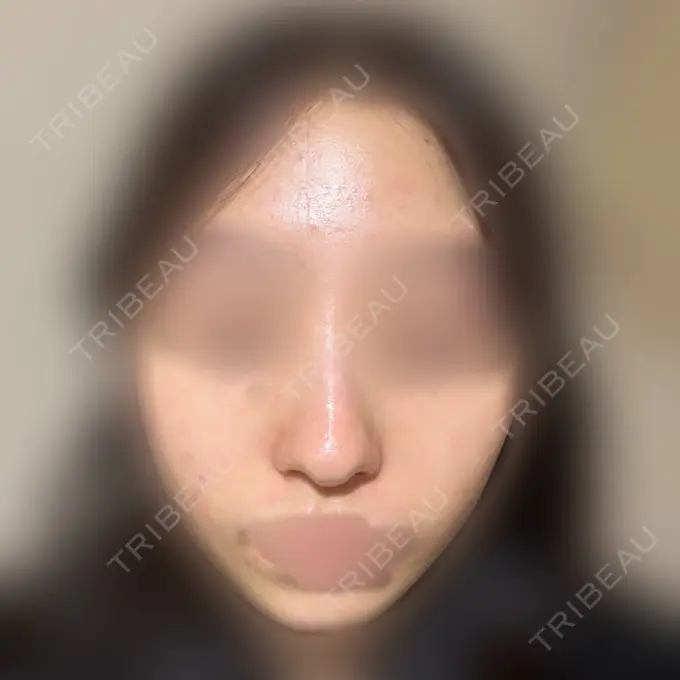 その他（肌） / 光治療（フォトフェイシャルなど） Lumiera Clinic DAY 0 メイン用