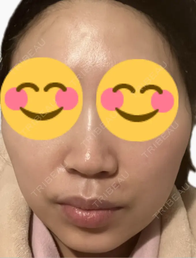 医療脱毛（顔） タイムルクリニック DAY 7 メイン用