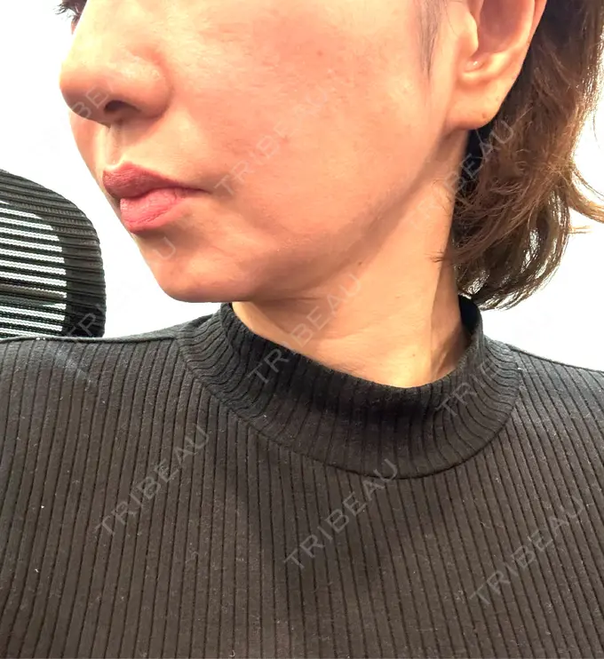 糸リフト / バッカルファット除去 / 脂肪吸引（顔） / 脂肪吸引注射（顔） 東京シンデレラ美容外科 池袋院 DAY 31 メイン用