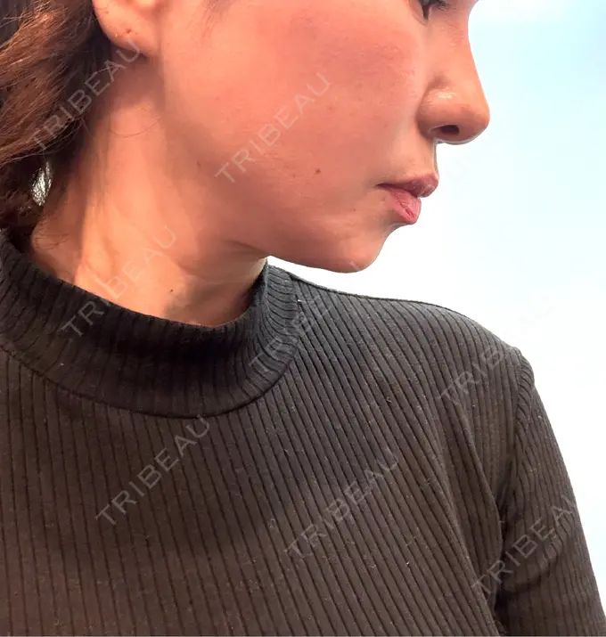 糸リフト / バッカルファット除去 / 脂肪吸引（顔） / 脂肪吸引注射（顔） 東京シンデレラ美容外科 池袋院 DAY 31 メイン用