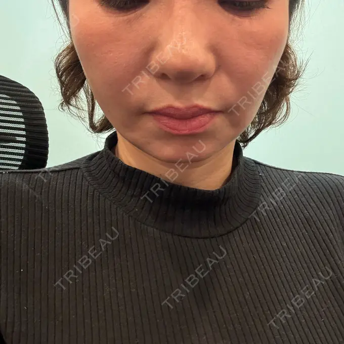 糸リフト / バッカルファット除去 / 脂肪吸引（顔） / 脂肪吸引注射（顔） 東京シンデレラ美容外科 池袋院 AFTER メイン用