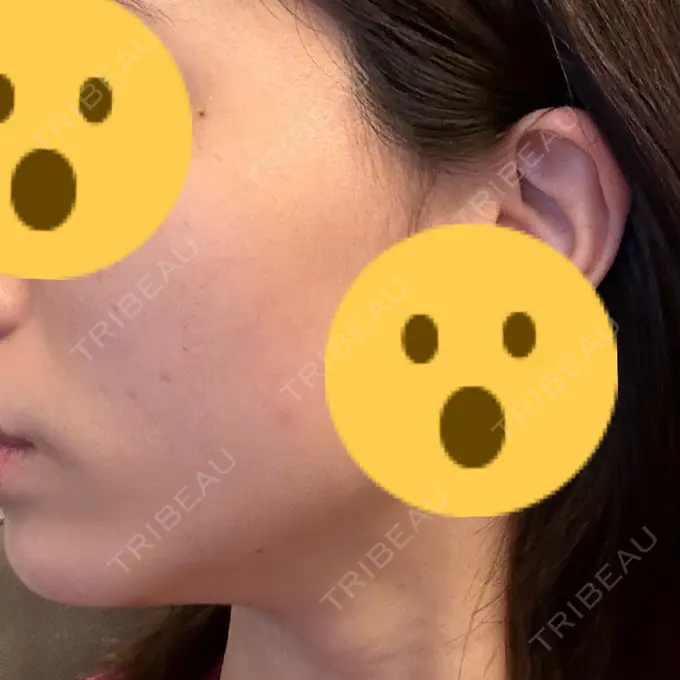 ハイフ（顔） 東京美容外科 福山院 DAY 26 メイン用