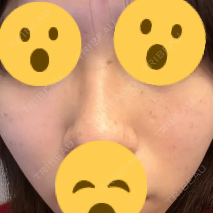 光治療（フォトフェイシャルなど） 東京美容外科 福山院 AFTER メイン用