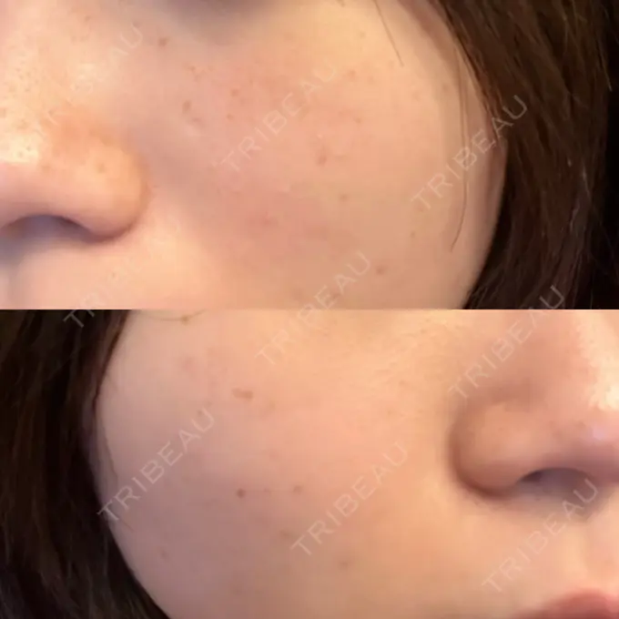 光治療（フォトフェイシャルなど） 東京美容外科 福山院 DAY 12 メイン用