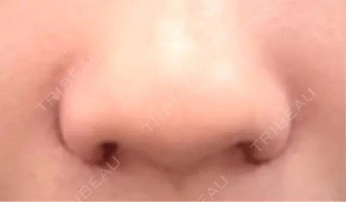 小鼻縮小（切開） くさのたろうクリニック DAY 2 メイン用