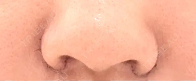 小鼻縮小（切開） くさのたろうクリニック DAY 4 メイン用