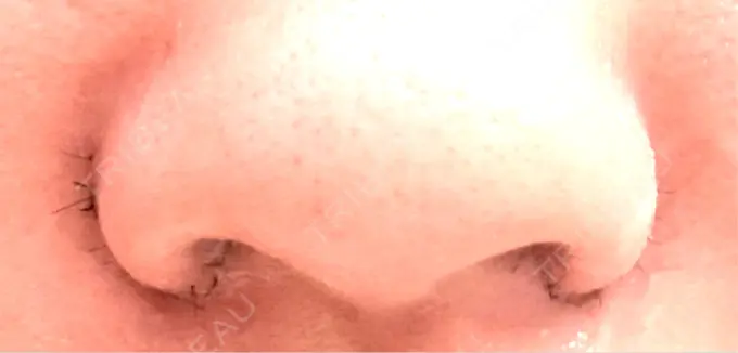 小鼻縮小（切開） くさのたろうクリニック DAY 3 メイン用