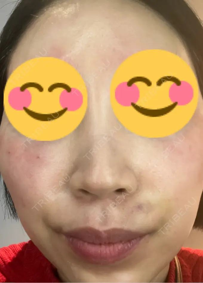 その他（肌） 美容皮膚科エルムクリニック 麻布院 DAY 0 メイン用