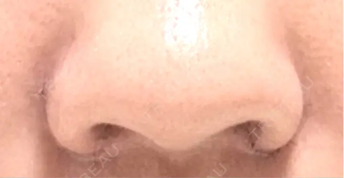 小鼻縮小（切開） くさのたろうクリニック DAY 5 メイン用