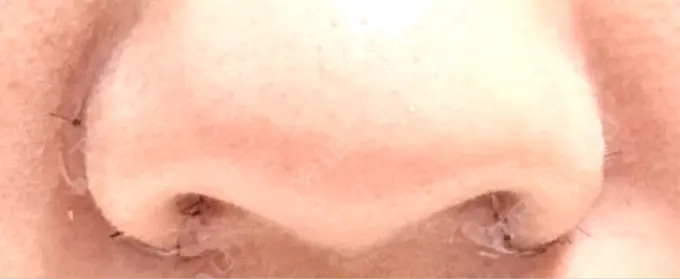 小鼻縮小（切開） くさのたろうクリニック DAY 6 メイン用