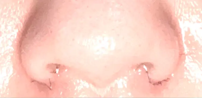 小鼻縮小（切開） くさのたろうクリニック DAY 7 メイン用