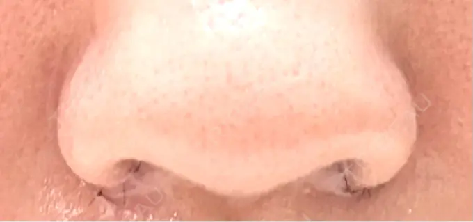 小鼻縮小（切開） くさのたろうクリニック DAY 8 メイン用