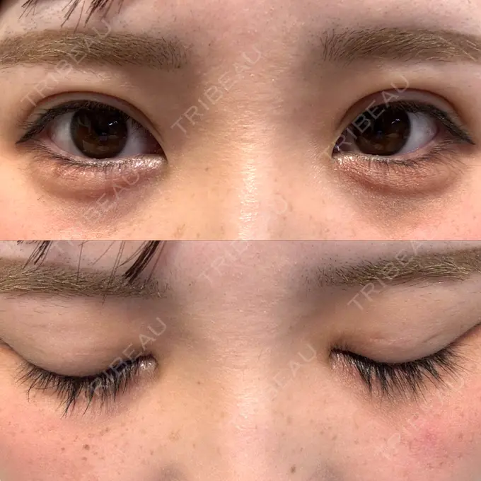 二重埋没 / ヒアルロン酸注入（涙袋） 恵聖会クリニック 京橋院 DAY 11 メイン用