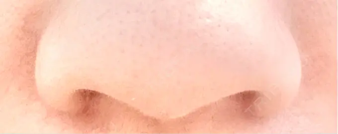 小鼻縮小（切開） くさのたろうクリニック DAY 14 メイン用