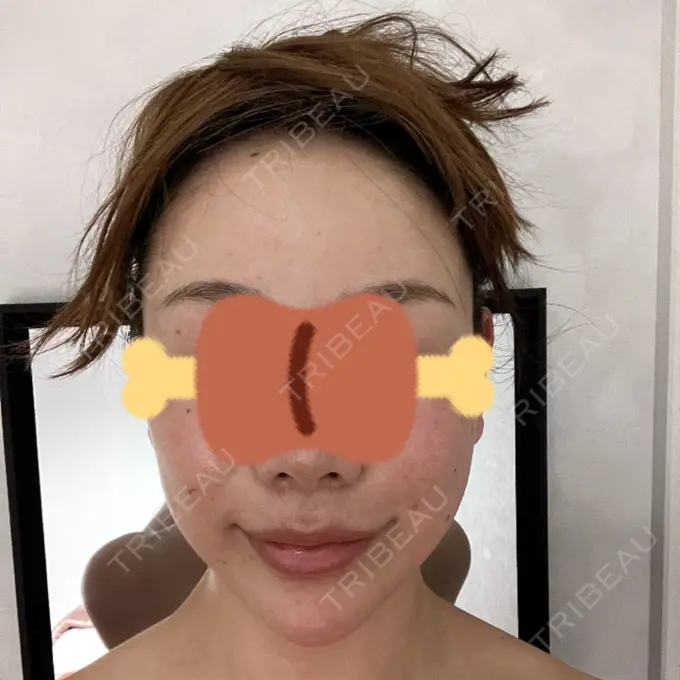 インディバ（顔） WOM SALON【術後ケア取扱いサロン】 DAY 0 メイン用