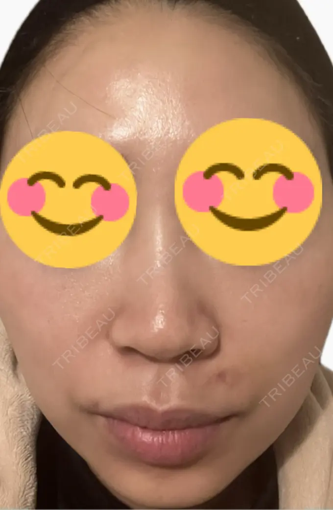 医療脱毛（顔） タイムルクリニック DAY 8 メイン用