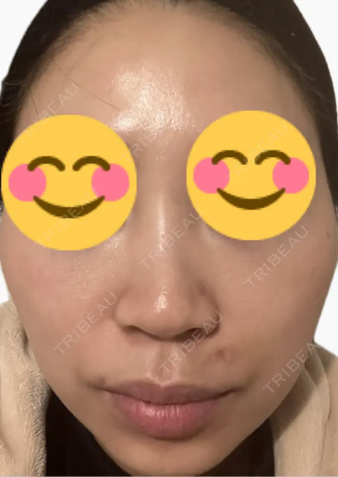 その他（肌） 美容皮膚科エルムクリニック 麻布院 DAY 1 メイン用