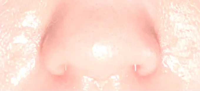 小鼻縮小（切開） くさのたろうクリニック AFTER メイン用