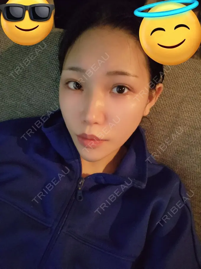 二重埋没 / ヒアルロン酸注入（涙袋） / シワ取りボトックス TCB東京中央美容外科 梅田大阪駅前院 DAY 361 メイン用