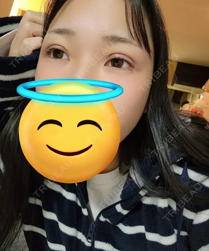 二重埋没 / ヒアルロン酸注入（涙袋） / シワ取りボトックス TCB東京中央美容外科 梅田大阪駅前院 AFTER メイン用