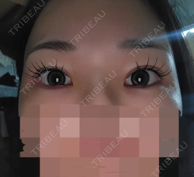 二重埋没 / ヒアルロン酸注入（涙袋） / シワ取りボトックス TCB東京中央美容外科 梅田大阪駅前院 DAY 361 メイン用