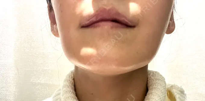 デンシティ First Clinic DAY 0 メイン用