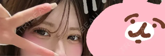 二重埋没 / 上まぶたの脂肪取り アリエル美容クリニック 水戸院 DAY 5 メイン用