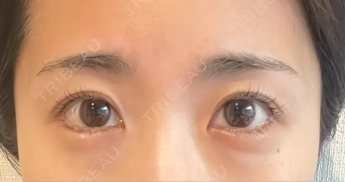 目尻切開 / タレ目形成・グラマラスライン（埋没） LOUIS CLINIC 二子玉川院【ルイクリニック】 DAY 11 メイン用