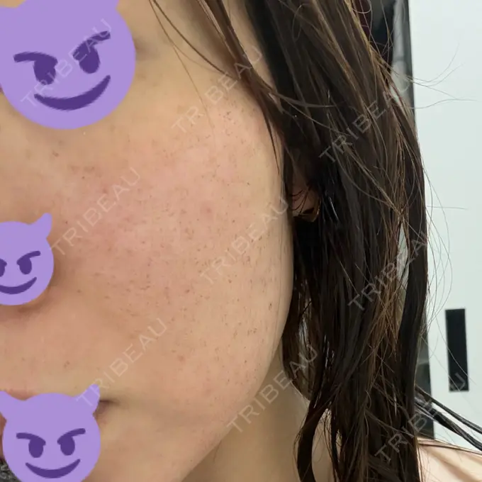 ルビーレーザー AZ BEAUTY CLINIC DAY 3 メイン用