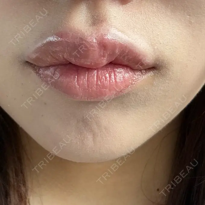 ボトックス（あご） / ヒアルロン酸注入（唇） アリエル美容クリニック 水戸院 DAY 0 メイン用