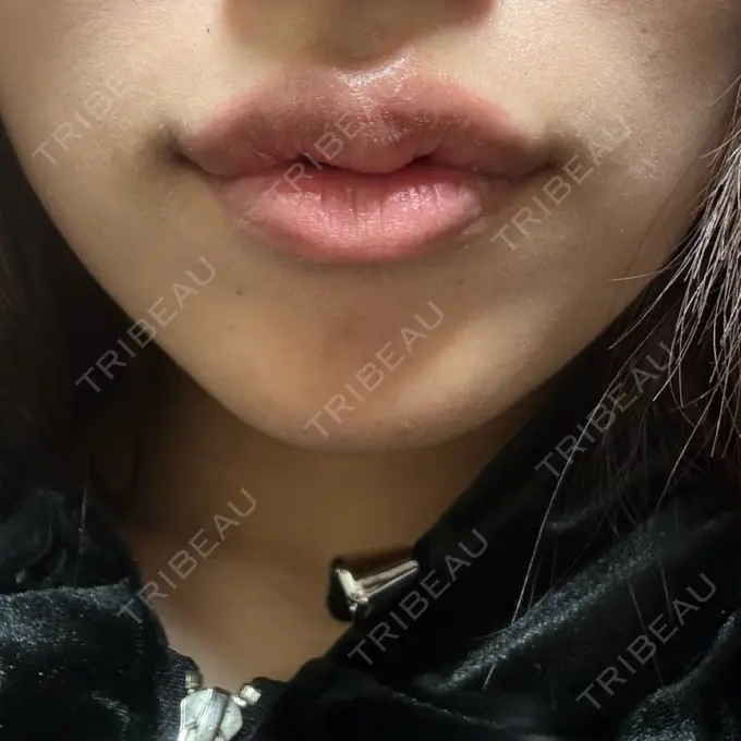 ボトックス（あご） / ヒアルロン酸注入（唇） アリエル美容クリニック 水戸院 DAY 2 メイン用