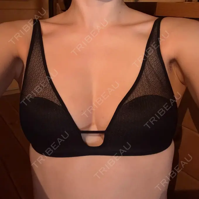 脂肪吸引（脚） / 豊胸（脂肪注入） 湘南美容クリニック Regno 銀座院 AFTER メイン用