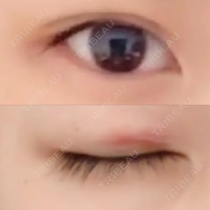 二重切開 よこはまエーブクリニック DAY 48 メイン用