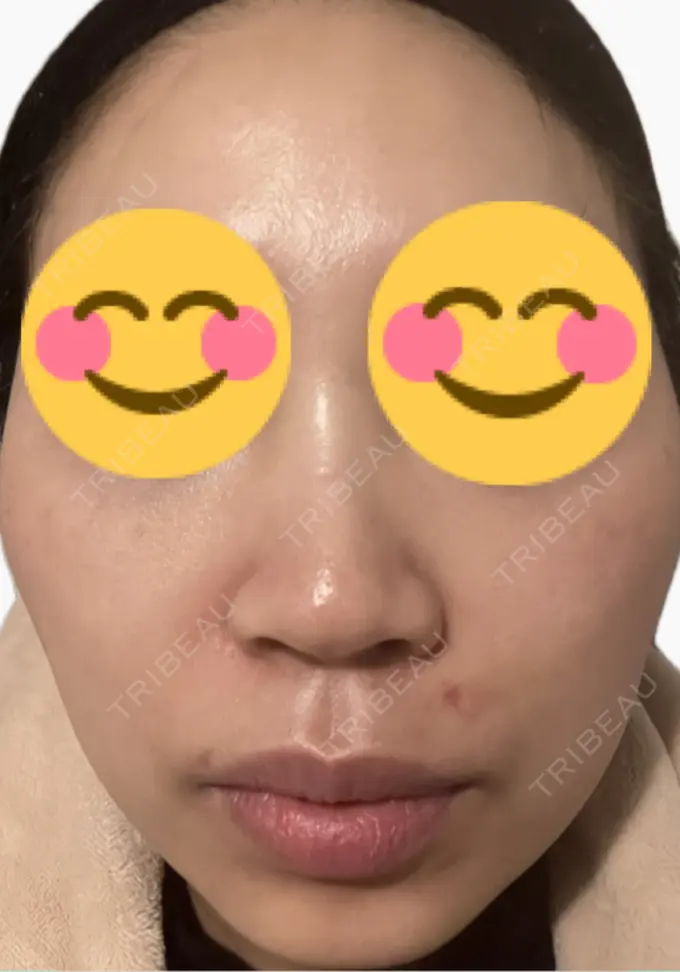 その他（肌） 美容皮膚科エルムクリニック 麻布院 DAY 3 メイン用