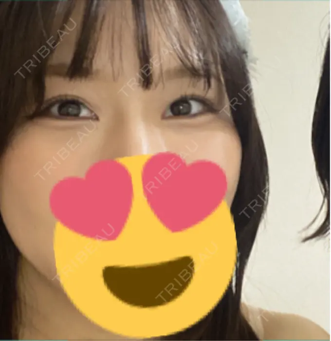 クマ治療 / 下まぶたの脂肪取り 新宿美容外科ネビュラクリニック AFTER メイン用