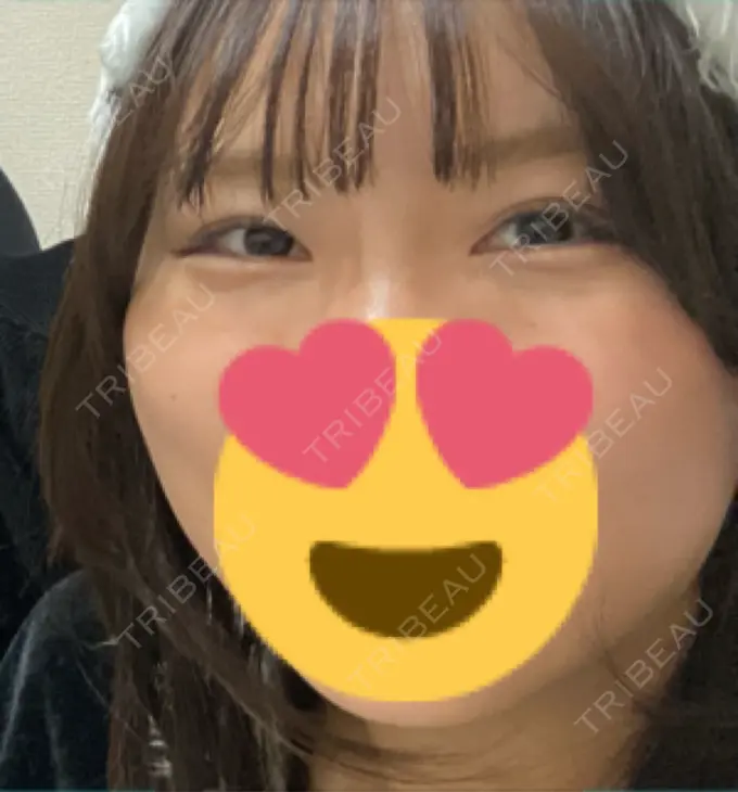 クマ治療 / 下まぶたの脂肪取り 新宿美容外科ネビュラクリニック DAY 15 メイン用