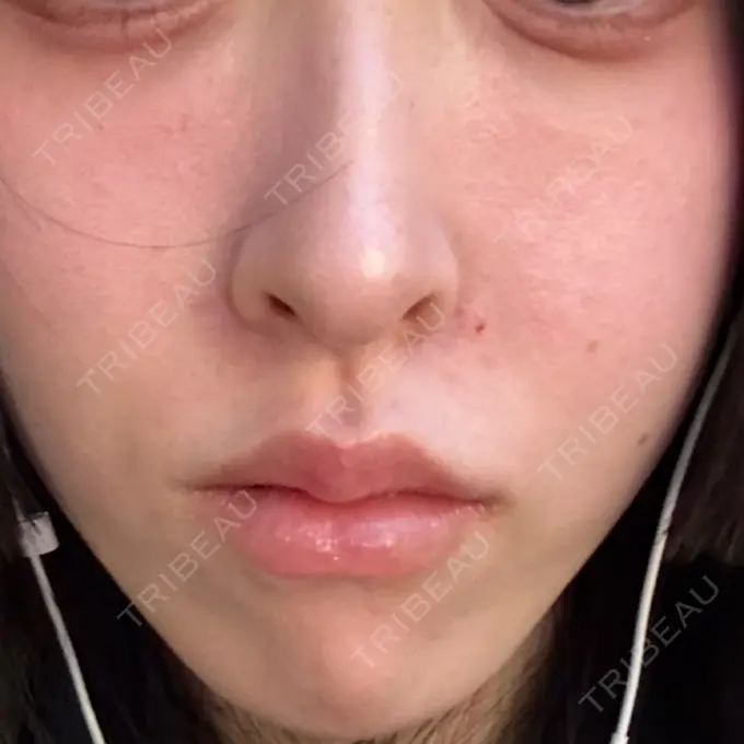 ヒアルロン酸注入（唇） / ヒアルロン酸注入（鼻翼基部） HAAB×DREAM BEAUTY CLINIC 大阪梅田院 DAY 0 メイン用