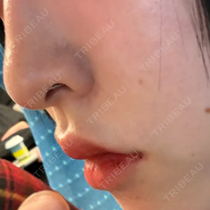 ヒアルロン酸注入（唇） / ヒアルロン酸注入（鼻翼基部） HAAB×DREAM BEAUTY CLINIC 大阪梅田院 DAY 4 メイン用